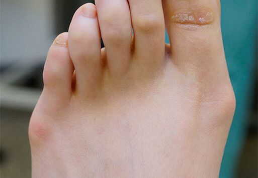 Valgo foot
