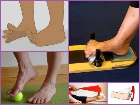 Exercise Therapy for Flatfoot-Valgus Deformity