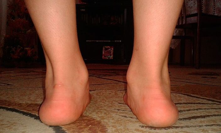 Flat feet in valgus
