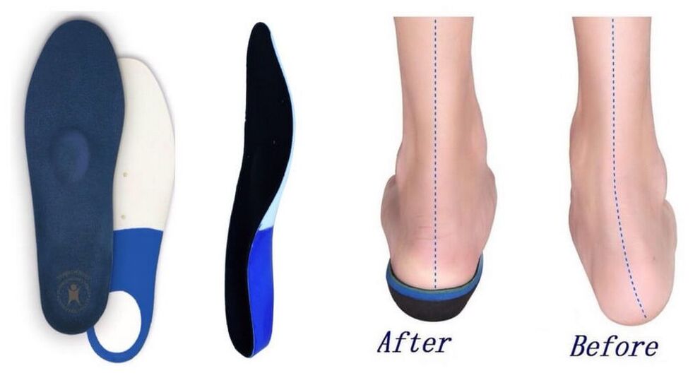 Orthopedic insoles for flat-valgus foot deformity