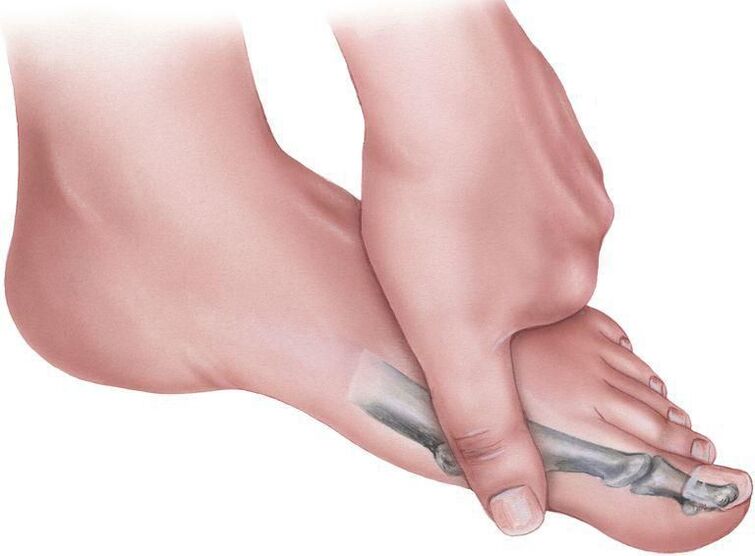Pain in the foot with plane-valgus deformity.