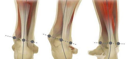 The norm of the axis of the foot and its curvature in case of plane-valgus deformity.