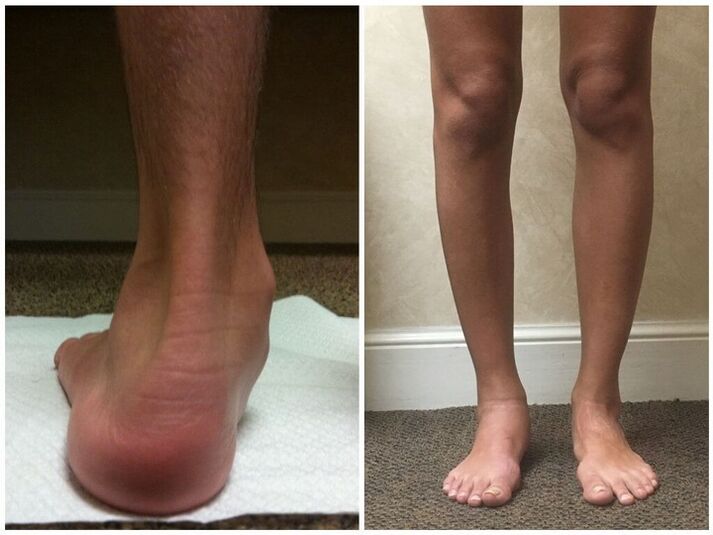 Legs with hallux valgus