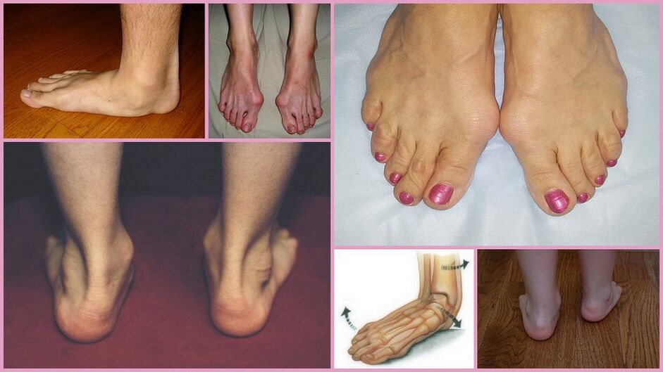 Manifestations of foot valgus in adults.
