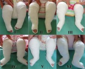 Casting procedures, each of which changes the position of the foot.