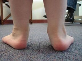 Flatfoot valgus deformity in a child