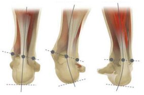 Normal foot, with deviation of the calcaneus in valgus and varus