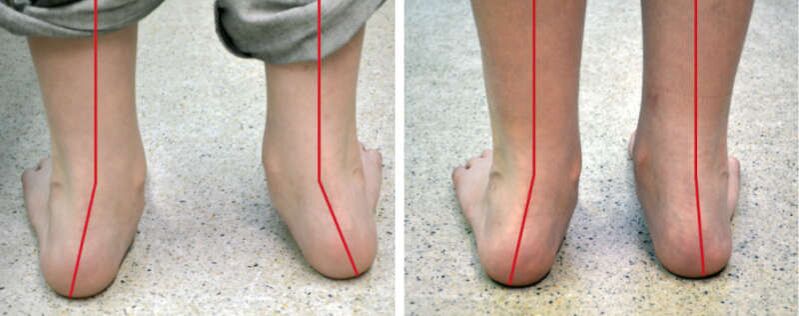 Valgo legs