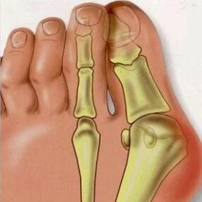 Valgus's reasons