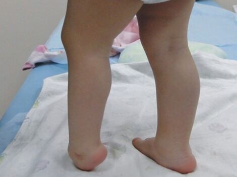 The first symptoms of the deformation of the feet