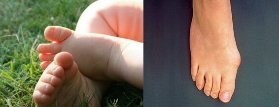 Valgo deformation of the first finger of the foot