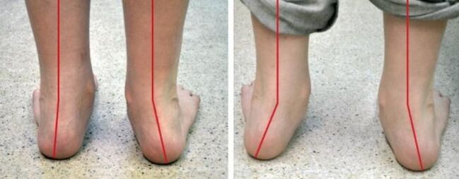 Valgo foot