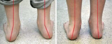 Valgo curvature